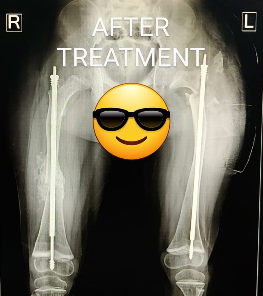 Bendy Brittle Bones — after treatment