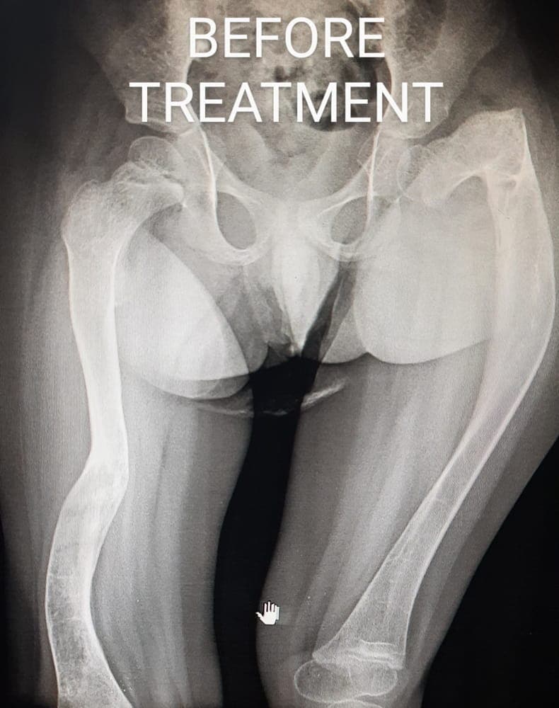 Bendy Brittle Bones — before treatment