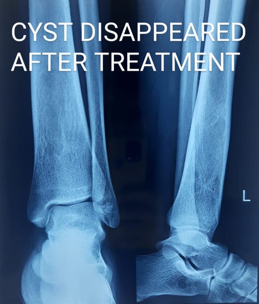 Bone Cyst — after treatment