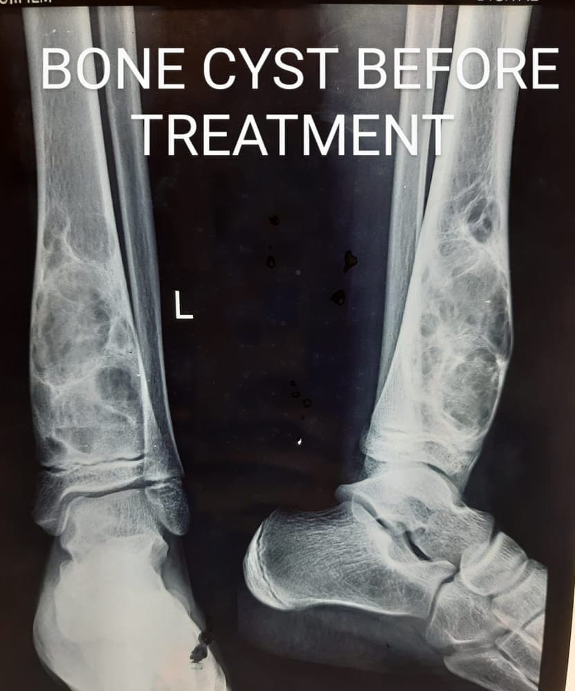 Bone Cyst — before treatment