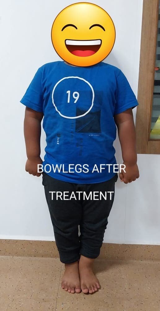 Bow Legs — after treatment