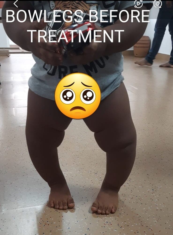 Bow Legs — before treatment