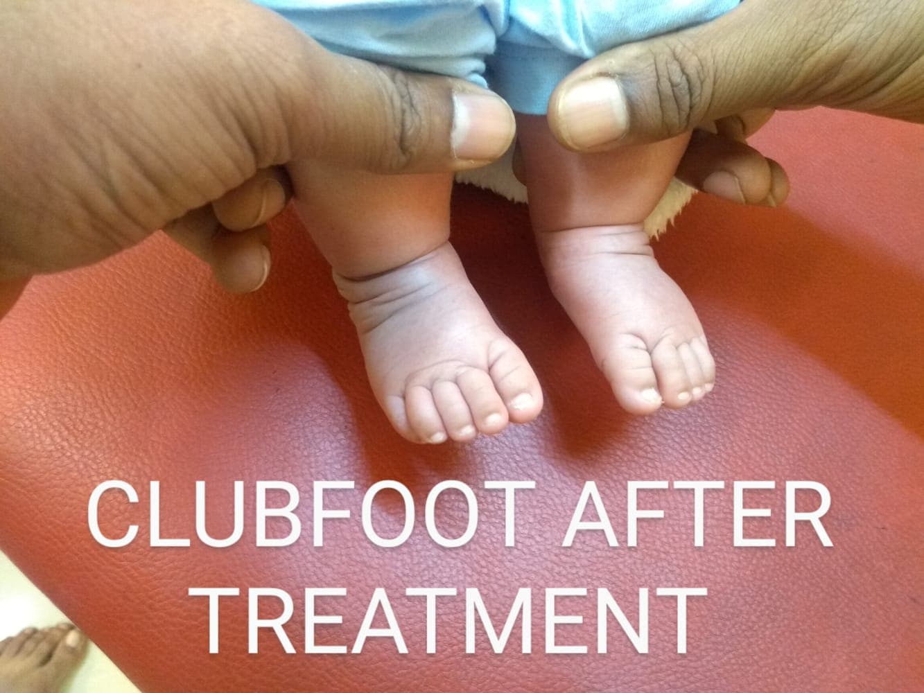 Clubfoot — after treatment