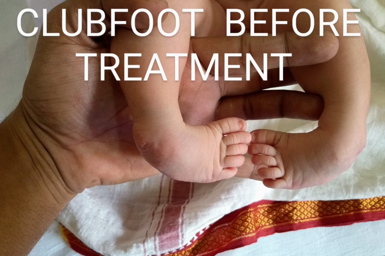 Clubfoot — before treatment