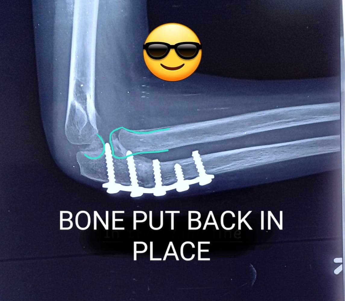 Dislocation — after treatment