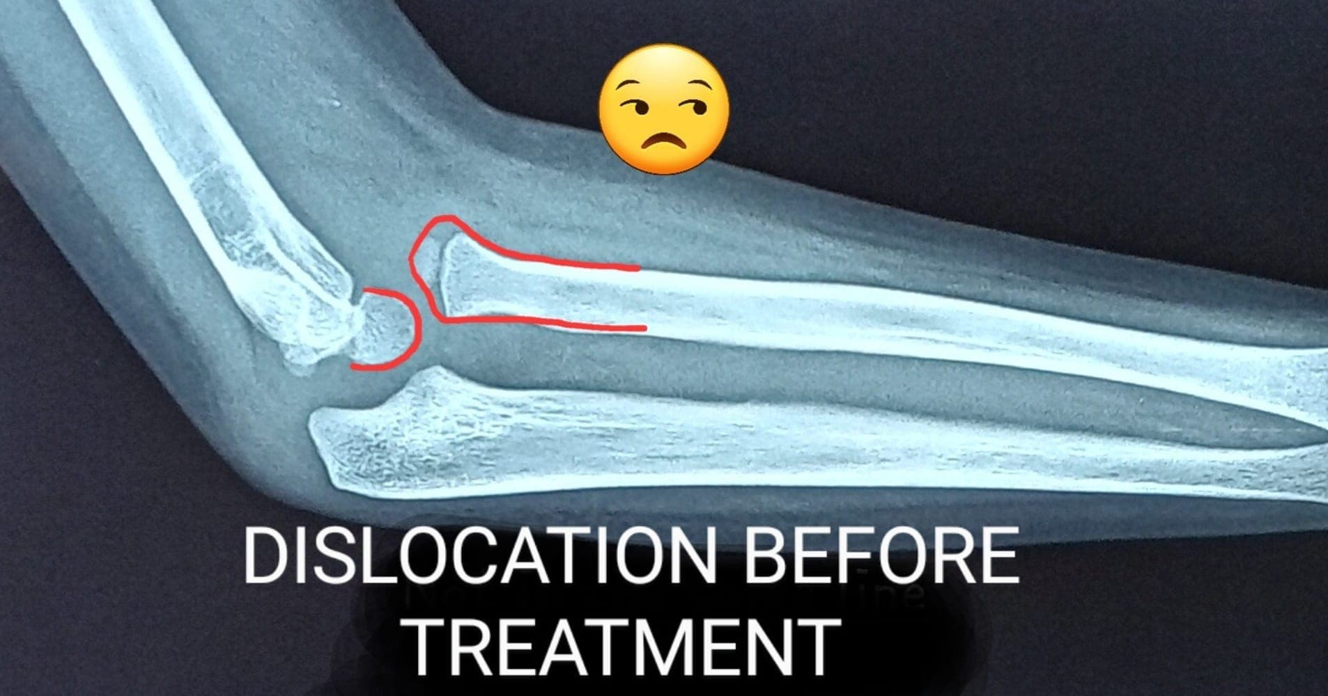 Dislocation — before treatment