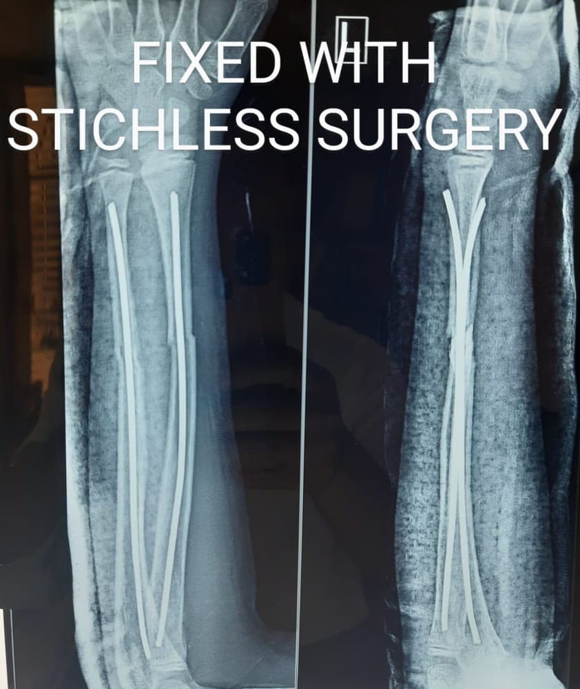 Fractures — after treatment