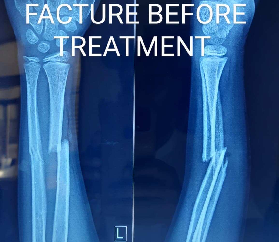 Fractures — before treatment