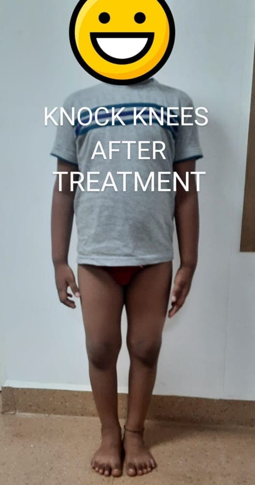 Knock Knees — after treatment