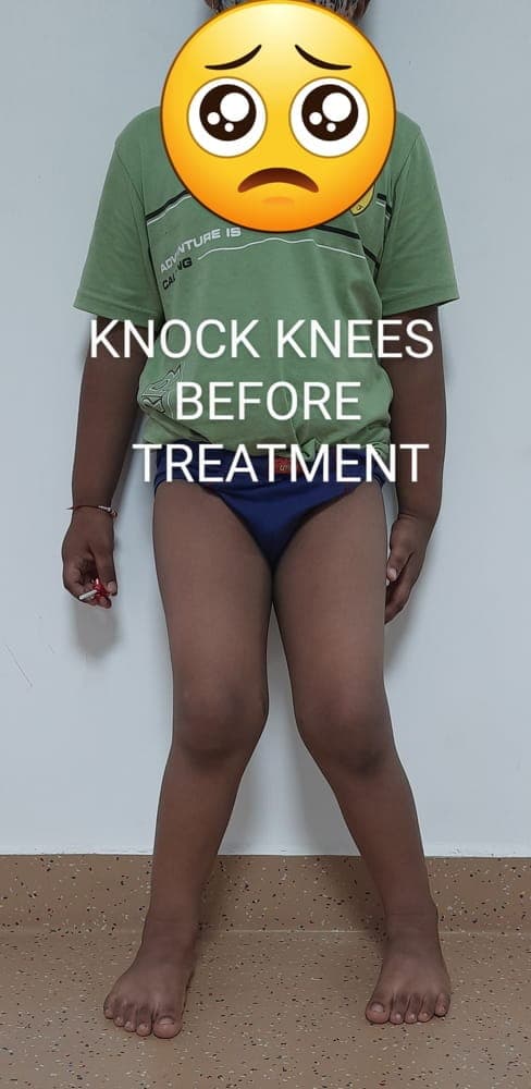 Knock Knees — before treatment